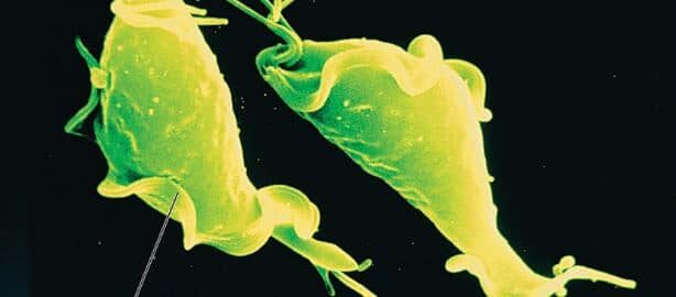 trichomoniasis image